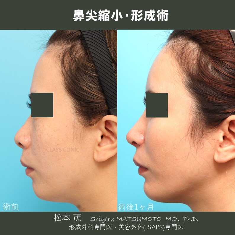 鼻整形术| 施術メニュー| CLASS CLINIC （クラスクリニック） | 東京 