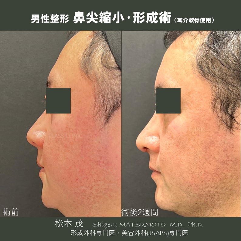 鼻整形术| 施術メニュー| CLASS CLINIC （クラスクリニック） | 東京 